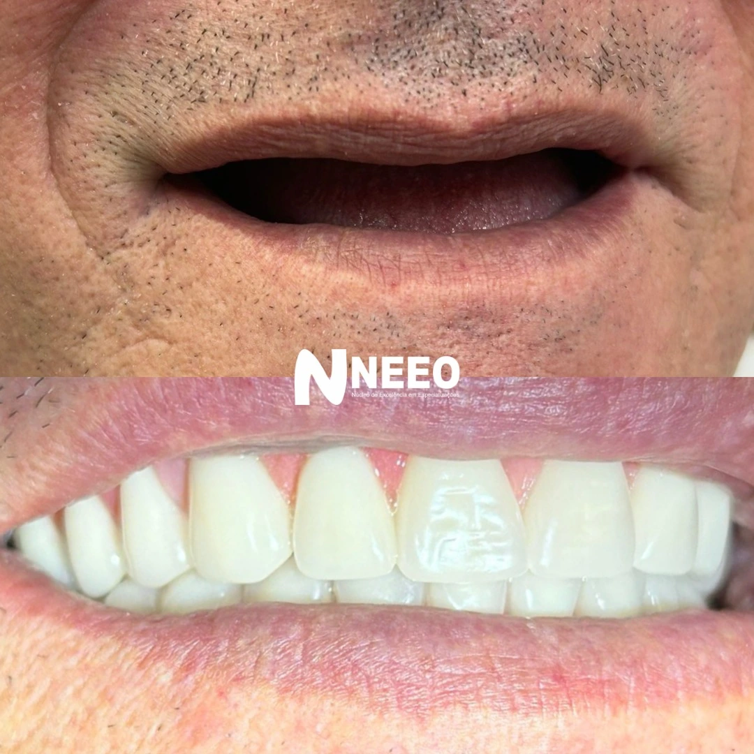Prótese Protocolo - WEBP