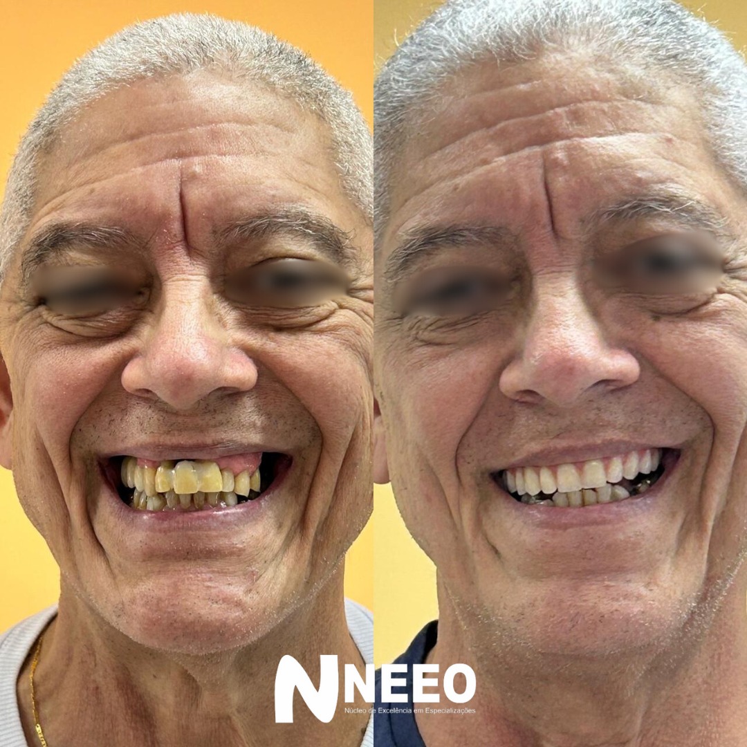 Prótese Protocolo